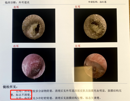 鼓膜检查